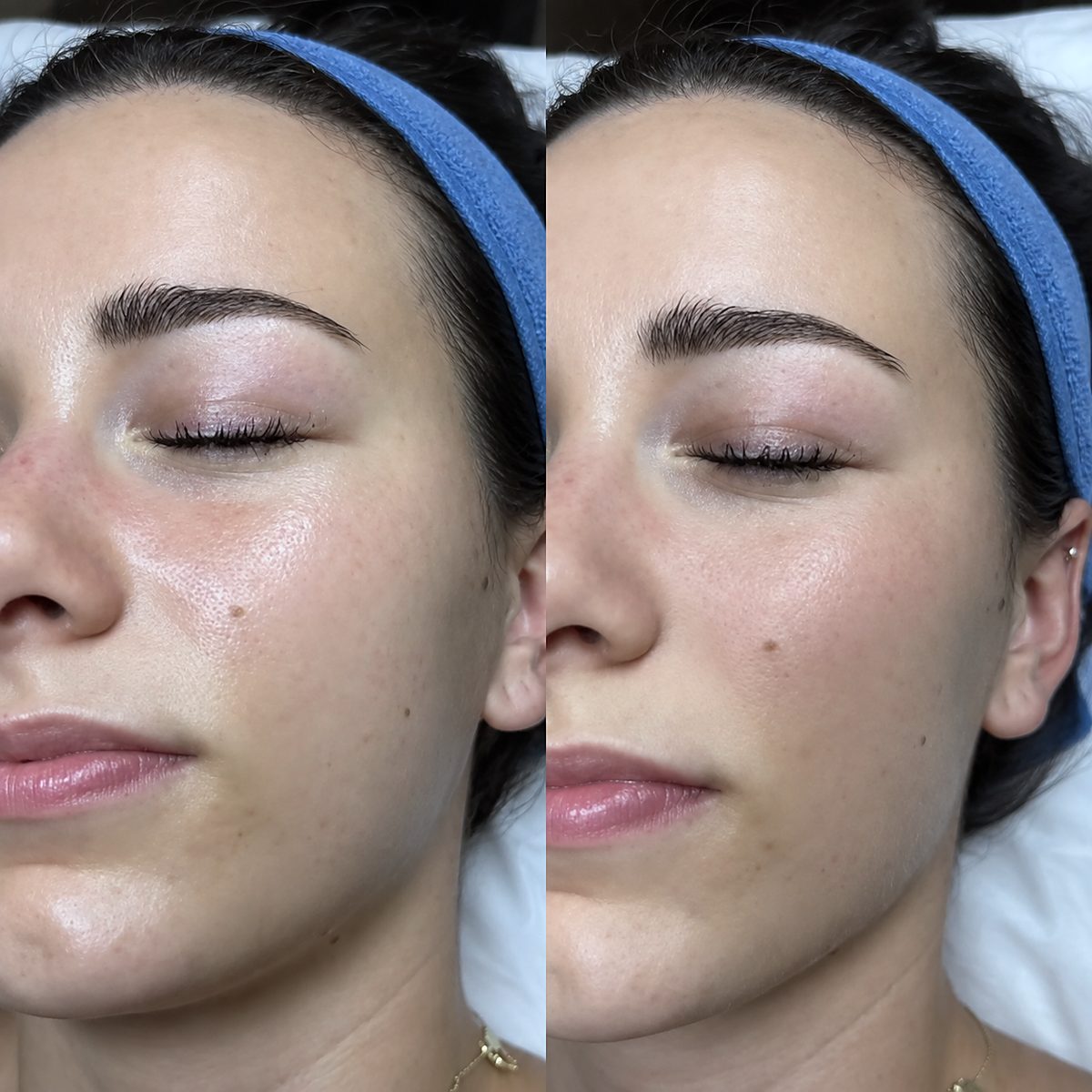 Kurs online dermaplaning